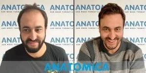 Cabeça de um homem antes do transplante capilar com calvície e após o transplante capilar com cabelos na cabeça