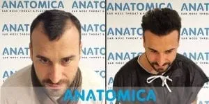 Cabeça de um homem antes do transplante capilar com calvície e após o transplante capilar com cabelos na cabeça