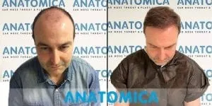 Cabeça de um homem antes do transplante capilar com calvície e após o transplante capilar com cabelos na cabeça
