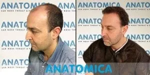 Cabeça de um homem antes do transplante capilar com calvície e após o transplante capilar com cabelos na cabeça