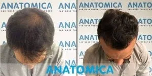 Cabeça de um homem antes do transplante capilar com calvície e após o transplante capilar com cabelos na cabeça