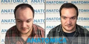 Cabeça de um homem antes do transplante capilar com calvície e após o transplante capilar com cabelos na cabeça